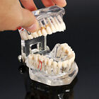 Dental Implant Disease Study Teachin Teeth Model With Restoration Bridge Tooth @