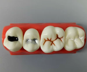 Dental Children Pit Fissure Sealant Sealing Model Child Pit Fissure Adhesive - Picture 1 of 3