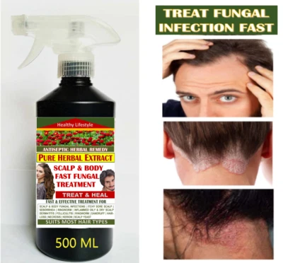 Tinea Capitis Ezcema Scalp & Body Fungal Treatment - PURE HERBAL EXTRACT 500 Ml - Image 1 of 4