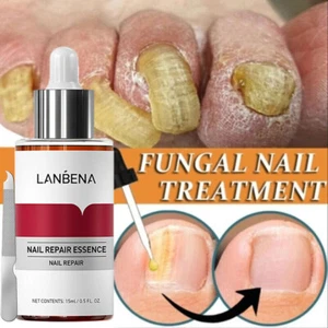 Suero para reparación de uñas tratamiento de uñas hongos líquido eliminación onicomicosis esencia del dedo del pie - Imagen 1 de 12