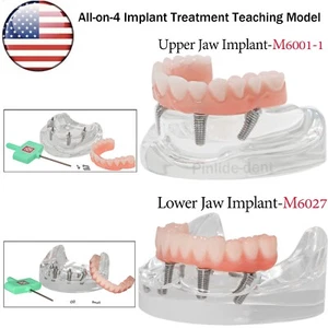 Implante dental de sobredentadura de EE. UU. modelo todo en 4 mandíbula superior/inferior transparente con 4 tornillos - Imagen 1 de 37