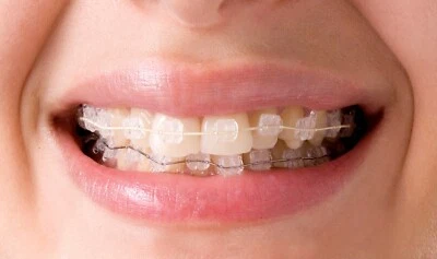 J&J Ortho™ Orthodontic White Coated Arch Wire Ovoid / Natural Optional (5/pk)