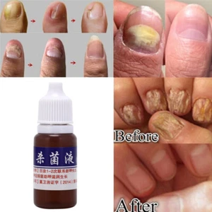 10ml Health Skin Care Nail Repair Treatment Liquid Cleanser Onychomycosis Rem-*- - Photo 1/11