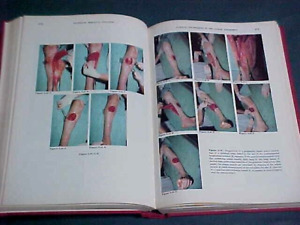 EXTERNE SKELETTFIXIERUNG ~ 1983 Dana C. Mears ~ Grafik Medizinisches Verfahren Buch