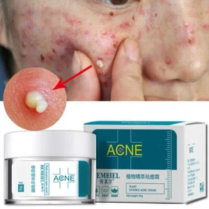 Crema Facial Anti Cicatriz del ACNÉ Granos Espinilla Blanqueadora Dejando POROS - Imagen 1 de 6
