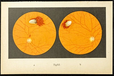 1896 - Lithography Ophthalmology: Injury of The Retina Per Un Sheen D Stainless - Bild 1 von 4