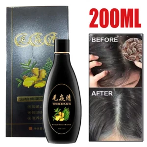 2025 Scalp Hair Follicle Shampoo Antibacterial Anti-Itching Mites Oil Control US - Picture 1 of 15