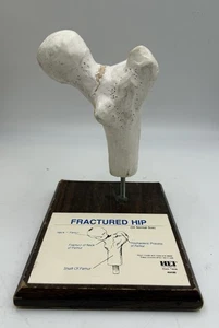 Health Edco  Fractured Hip Femur Bone Health Education Anatomical Model - Picture 1 of 5