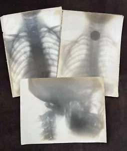 X-Ray Early 20th Century Photographs of Children With Throat Obstructions - Picture 1 of 6