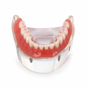 Modelo de implante dental demostración restauración de sobredentaduras postizas con implantes inferiores - Imagen 1 de 8