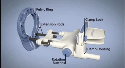 Dispositivo completo de terapia de tracción pene RestoreX utilizado para la enfermedad de Peyronie’s Foto 1 de 3