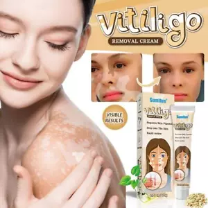 Vitiligo Removal Cream Natural White Spot Treatment Leucoplakia Fast Acting C6Q4 - Picture 1 of 22