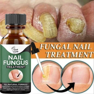 Nail Fungus Treatment Essence Serum Care Hand and Foot Care Removal Repair Gel - Picture 1 of 12