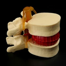 Anatomical Spine Lumbar Disc Herniation Anatomy Medical Teaching Tool Models New