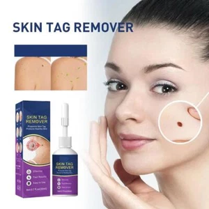 Warts Removal Spray Warts Treatment Spray Skin Tag Painless 20ml Remover ❁❀ - Photo 1/10