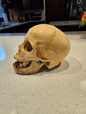antique medical anatomy child skull science anatomical disease - Image 1 of 4
