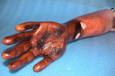 Lehrmodell menschlicher Körper Verbrennung Hand Burn Teaching Model Human Bodies