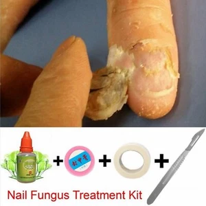 Chinese Nail Fungus Treatment Repair, Anti Fungal Nail Infection Kit (3 bottles) - Picture 1 of 7