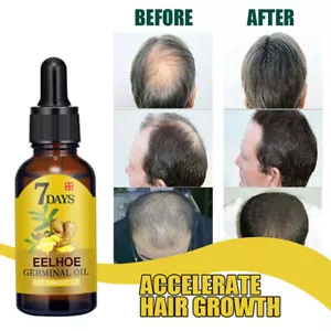Ginger Fast Hair Growth Loss Serum Essential Oil Anti Preventing Hair Loose 🔥✅ - Picture 1 of 5