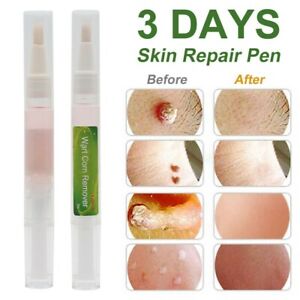 Skin Tag Removal Treatment Cream Face Care Mole Corn Wart Remover Natural Pen UK