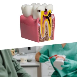 6 Times Caries Tooth Model Teaching Prop for Students Demonstration Teachers - Picture 1 of 5