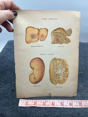 vintage medicine litho print 1916 stanley liver kidney disease victorian medical - Image 1 of 4