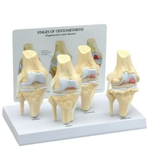 Knee 4-stage Osteoarthritis Anatomical Model LFA #1100 SEE VIDEO. Make An Offer! - Picture 1 of 4