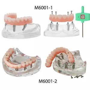 Implante dental todo en 4/6 sobredentadura modelo mandíbula superior restauración 4/6 tornillos - Imagen 1 de 26