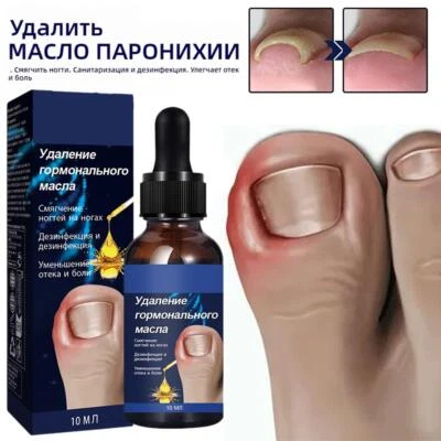 -Tratamiento de hongos en uñas de los pies uñas hongos aceite esencial onicomicosis Foto 1 de 4