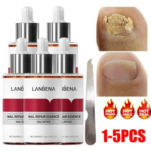 5/3x Nagelpilz Reparatur Essenz Serum + Nagelfeile Hand Füße Behandlung Nagelreparatur - Bild 1 von 17