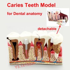 Dental Anatomy Detachable caries plastic teeth Anatomical model demonstration