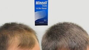 MINOXIL FORTE FOR HAIR LOSS