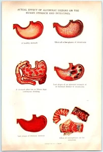 1916 Alcohol Effects on Human Stomach Intestines Print Book Plate EJ Stanley KK - Picture 1 of 2