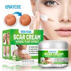 Acne Scar Spots Removal Cream Burns Stretch Repair Gel Treatments New U5u8