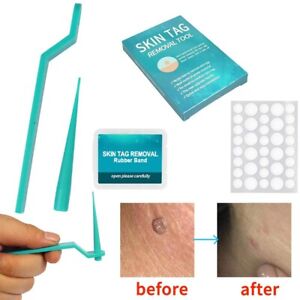 20Pcs Rubber Band Skin Tag Removal Kit for Easy and Convenient Application