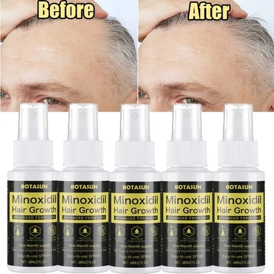 BOTASUN 3/5Stück Minoxidil 5% Haarwachstum Serum Spray für Männer 1-5 Monats Vorrat 60ml