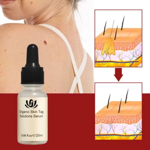 12-Hours Wart Remover Skin Tag Mole Remover Eliminate Foot Corn Wart Liquid 20ml - Picture 1 of 12