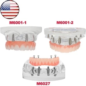 US Dental Overdenture Restoration Teeth Model With 4/6 Screws Upper/Lower Jaw - Picture 1 of 56