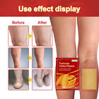 Pain Relief Spider Leg Treatment Anti Swelling Phlebitis Plaster New 6Pcs/Bag
