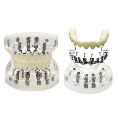 Модель зубного имплантата верхняя нижняя челюсть 6 имплантатов модель для восстановления зубных протезов - Изображение 1 из 4