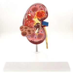 Diseased Kidney Model Human Anatomical Medical Pathological Changes Specimen - Picture 1 of 4