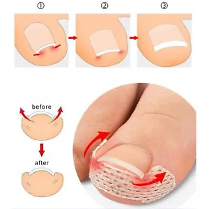 Ingrown Toenail Treatment: 120Pcs Breathable Ingrown Toenail Corrector Strips - - Picture 1 of 11