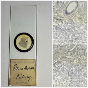 Antique Microscope Slide. Showing Drunkards Kidney. By Thomas Groves. - Picture 1 of 3