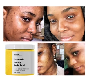 Skin Whitening Dark Spots lightening Acne Brightening Turmeric Honey Kojic Acid - Picture 1 of 5