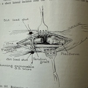 Surgery of the Hand Bunnell Third Impression 1948 Medical Book Drawings - Imagen 1 de 9