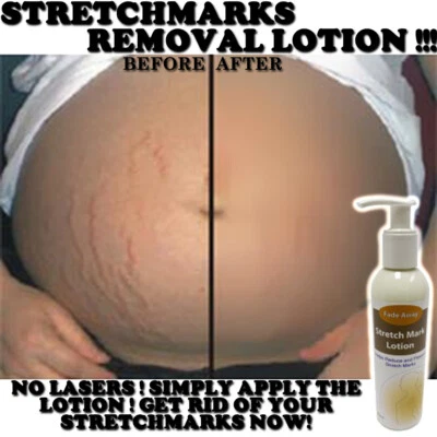 FADE AWAY STRETCH MARK LOTION CREAM MAX STRENGTH REMOVES STRETCH MARKS - Image 1 of 2