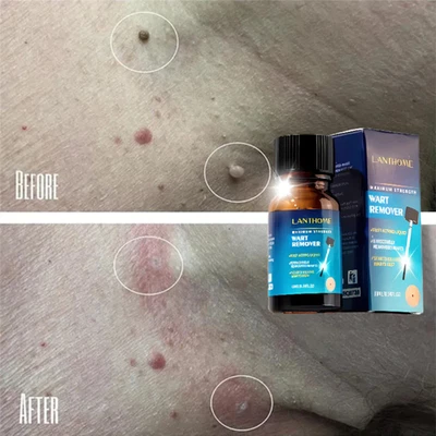 Mole Wart Rem0ver  Natural Multi-Purpose Skin Care Serum Spot for Moles 10 ml - image 1 of 4