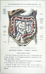 MÉDECINE - ÉCORCHÉ: MALADIE de l'INTESTIN - Gravure du 19e siècle - Picture 1 of 2