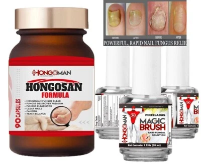 HONGOMAN - HONGOSAN Antifungal toenail athlete's foot support athletes foot fungus nail skin