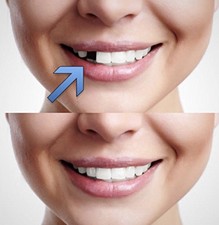 Provisorischer Zahnersatz  Quick Dental Tooth Zähne Reicht für bis zu 20 Zähne